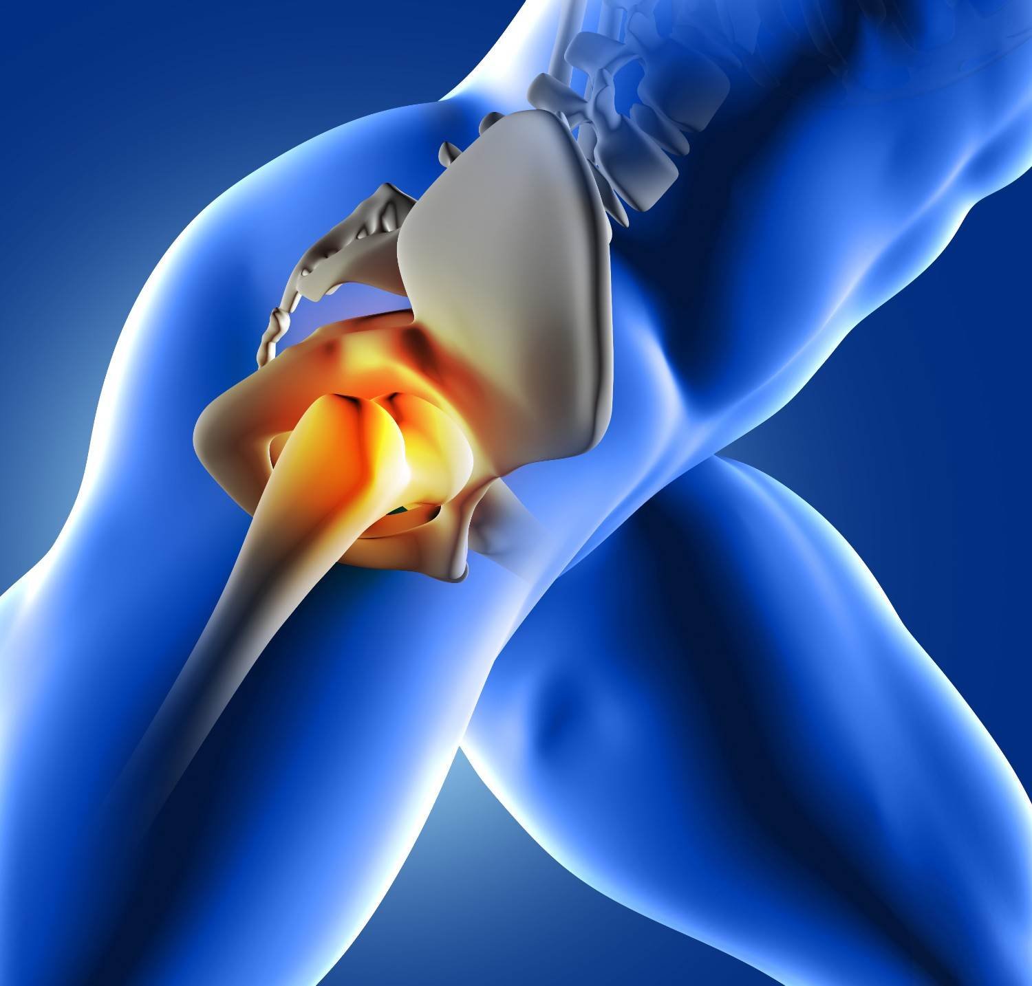 Hip Replacement Surgery in West Delhi