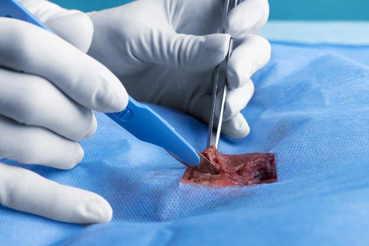 Arthroscopy (Keyhole Surgery)